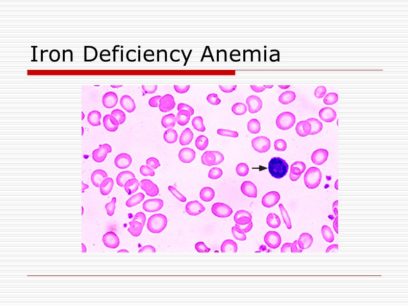 Iron Deficiency Anemia